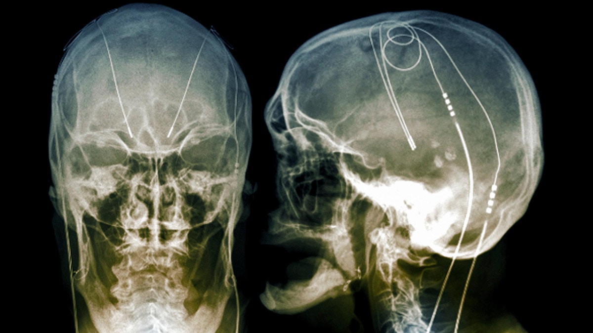 C0269906 Parkinson S Brain Pacemaker X Ray Spl Small1 1