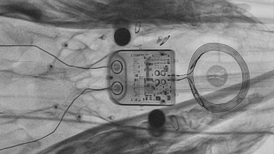 brain computer interface implant x-ray